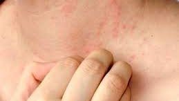طرق علاج والوقاية من حمو النيل والدمامل للكبار والأطفال