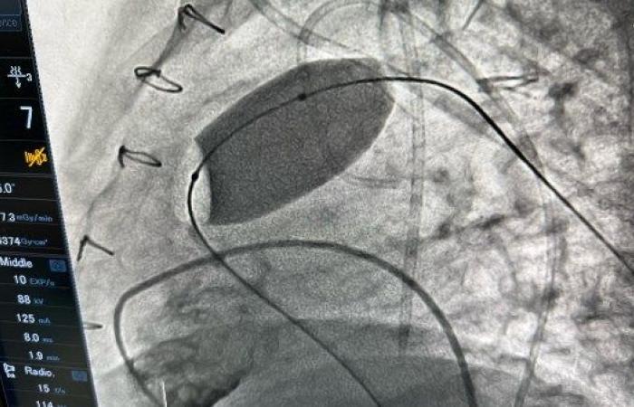 الصحة: نجاح عملية دقيقة لتغيير الصمام الرئوي بالقسطرة في أكاديمية قلب المبرة - خليج نيوز